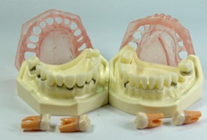 牙周病模型 牙周病模型